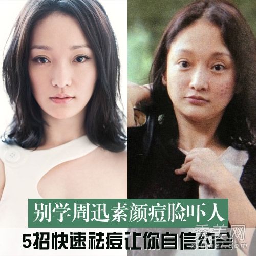 周迅变“脸痘脸”教你5种快速祛痘方法