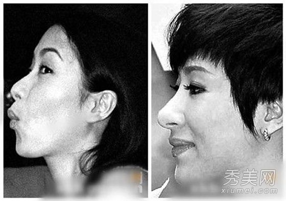 关注鼻子整形的女演员杨毅每六个月检查一次鼻子。