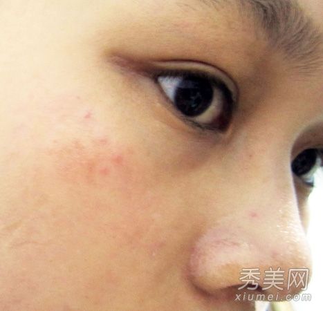 黑麻子和凹麻子教你4种护肤方法。