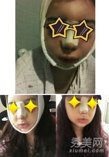 整容案例:为一个有着大脸蛋的才女做了30天的整容手术