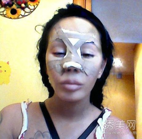 俄罗斯女性整形手术失败13次