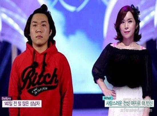 韩国女性版史莱克多毛女性的成功整形经验