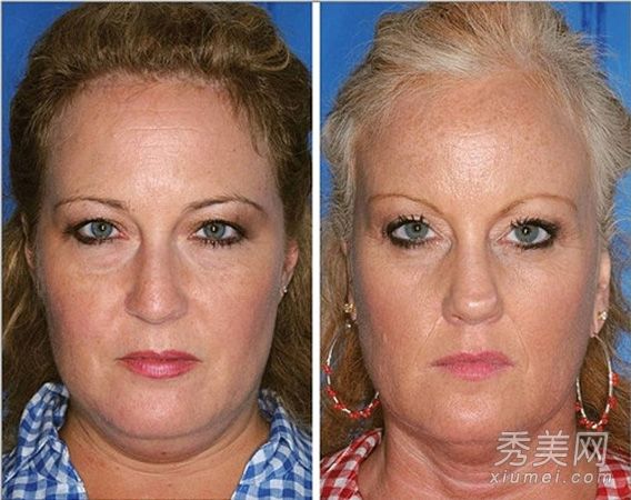 吸烟变得丑陋，皱纹双胞胎相反作证(照片)