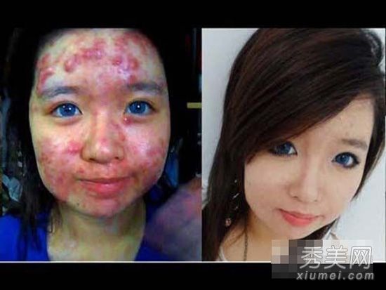 历史上最强的“痘痘女人”化妆品来拯救发炎的脓包