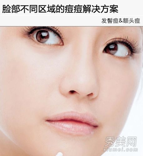 面部痤疮反射区:如何解决各个部位的痤疮？