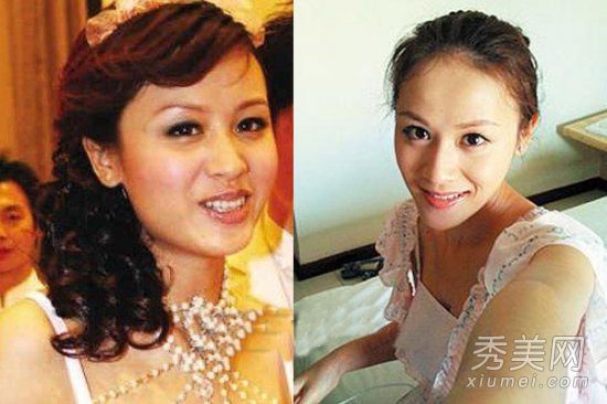 叶一茜涉嫌在18星整容手术前后削骨削面