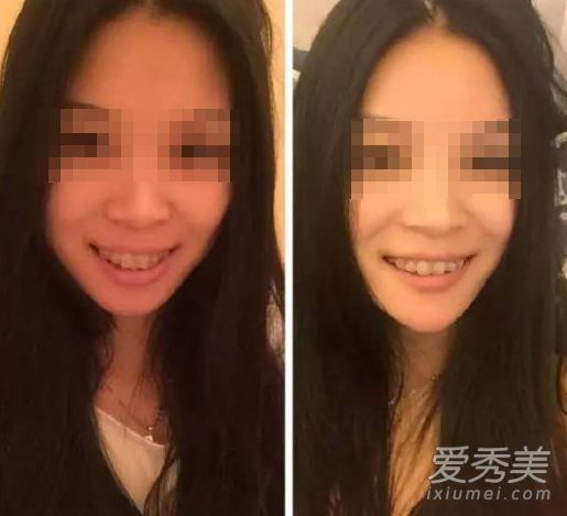 牙齿矫正前后20组的效果优于美容手术。