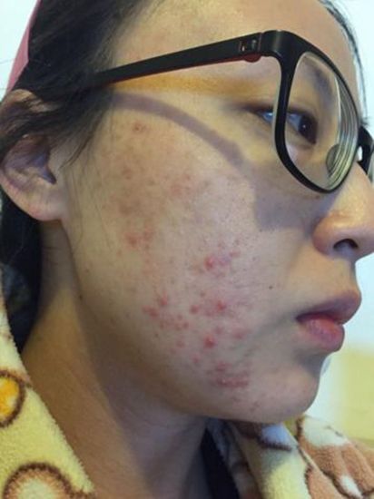 一位三岁的幼儿园老师用苹果敷料治好了她的粉刺。