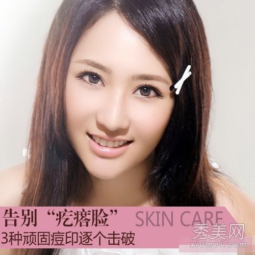 黑麻子&如何消除麻子?