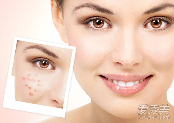 面部痤疮的治疗:修复痤疮疤痕的四种方法