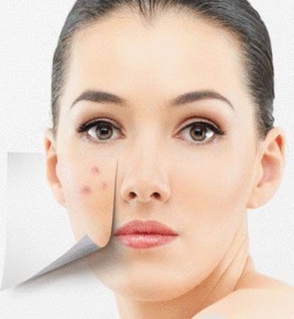 下巴长痘痘吃什么排毒祛痘？