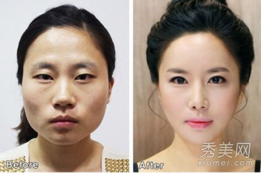 韩国医院开放整形手术照片惊人的整形手术