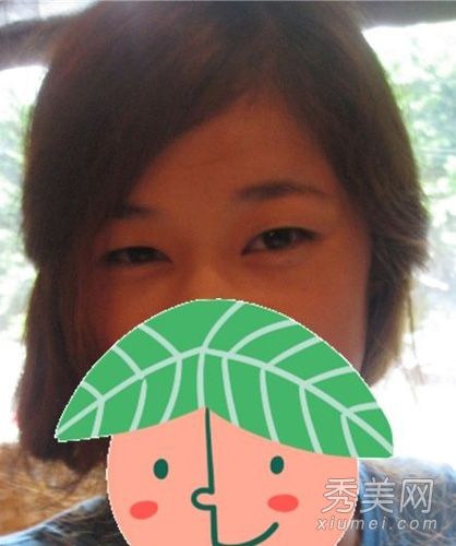 揭示整容手术的过程:双眼皮切割+隆鼻+骨骼切割和实拍