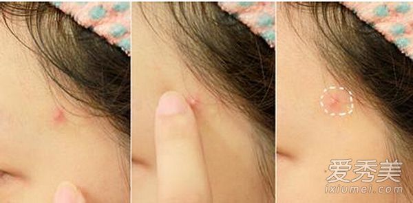 太阳穴长痘痘的原因如何调理祛除痘痘？