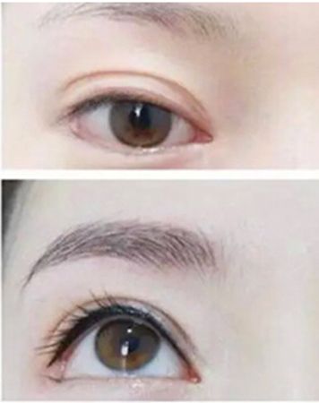 什么是虹膜线？不同眼图的虹膜线条效果图