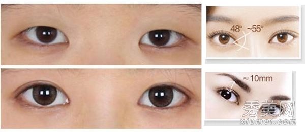 眼部整形手术明星在拍照前后打开眼角并切开双眼皮。