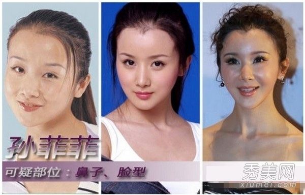 整容女演员天天换脸孙菲菲喜欢整容男