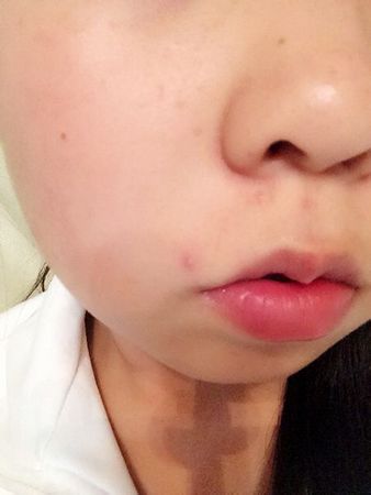 简单实用的祛痘窍门绿豆和枸杞也能祛痘。