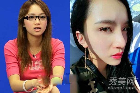 整形手术中的李媛希面部变形