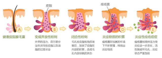 如何去除粉刺？痤疮和痤疮的区别